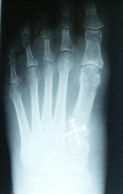 xray of foot after image for toe surgery