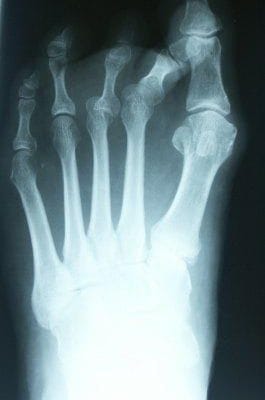 xray of foot before image for toe surgery
