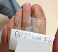 photograph of toenail fungus treatment