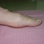 photograph of foot before bunion surgery