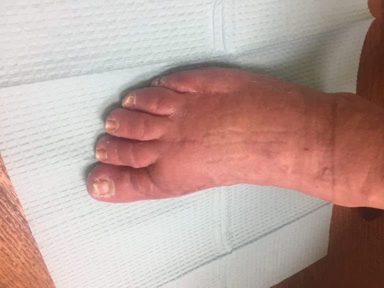 the after surgery photograph showing a foot with hammertoe