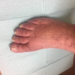 the after surgery photograph showing a foot with hammertoe