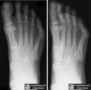 xray of before and after bunionette